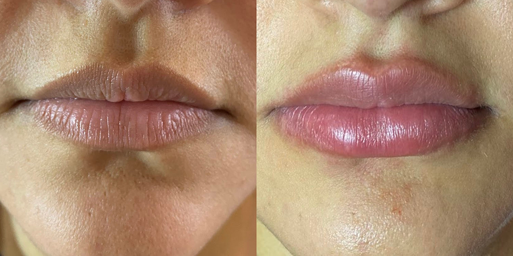 Perfilamiento de labios