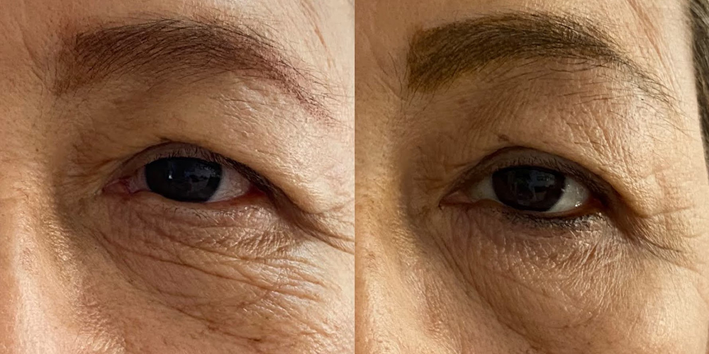 Rejuvenecimiento de ojeras
