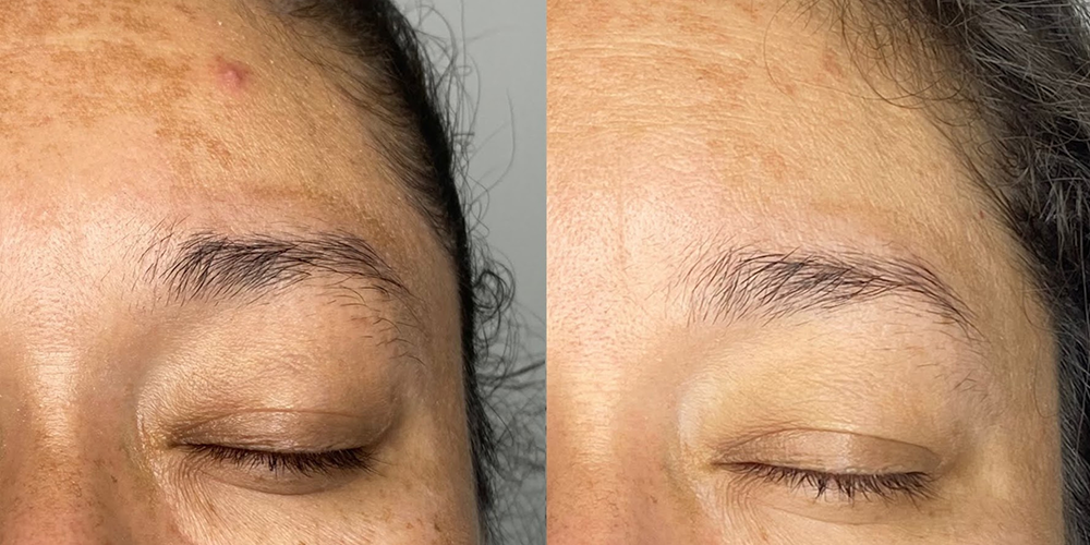 Melasma