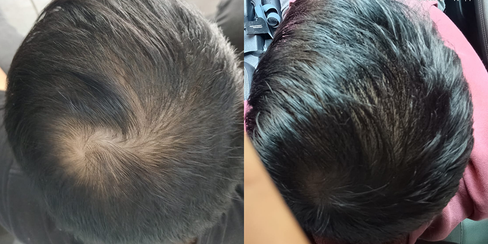 Alopecia androgenica