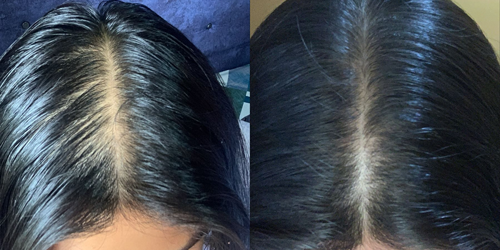 Alopecia androgenica