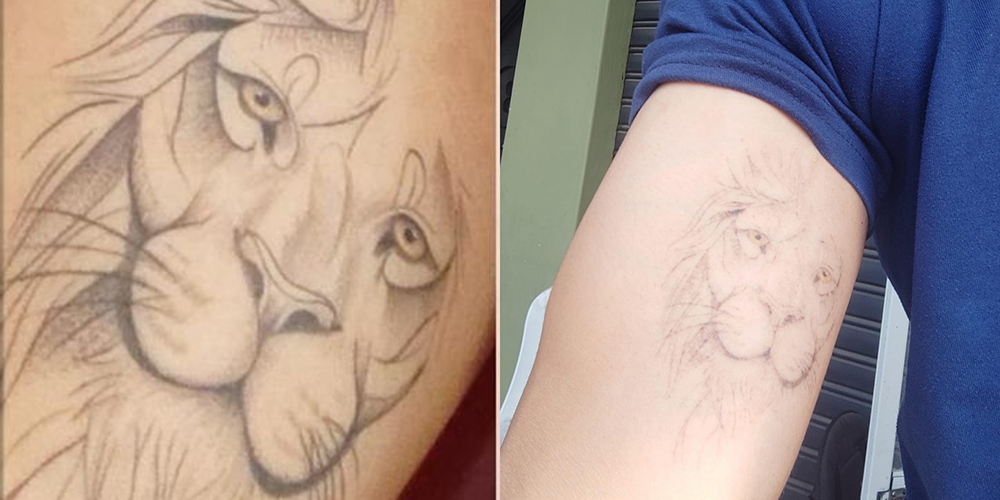 Borrado de tatuaje