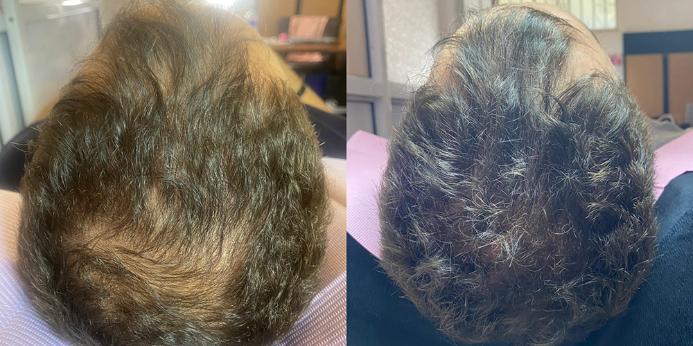 Alopecia androgenica