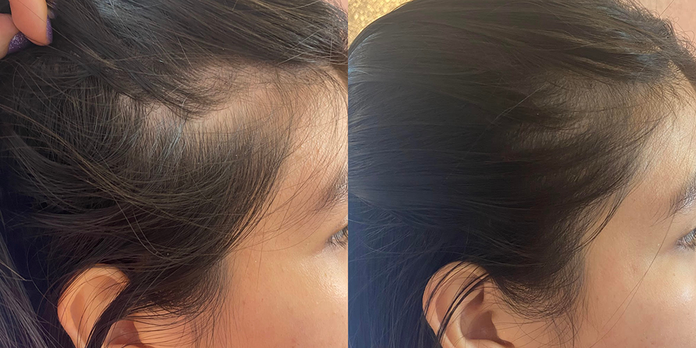Alopecia androgenica