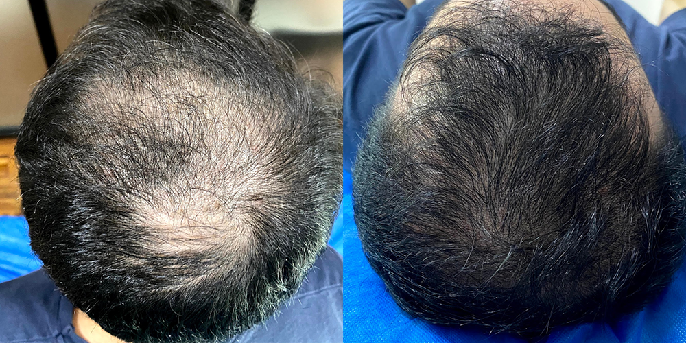 Alopecia androgenica