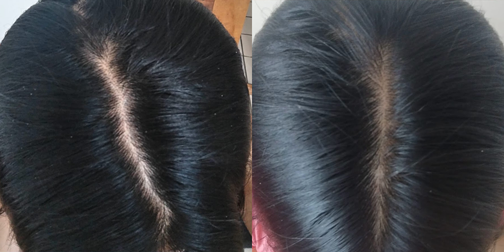 Alopecia androgenica