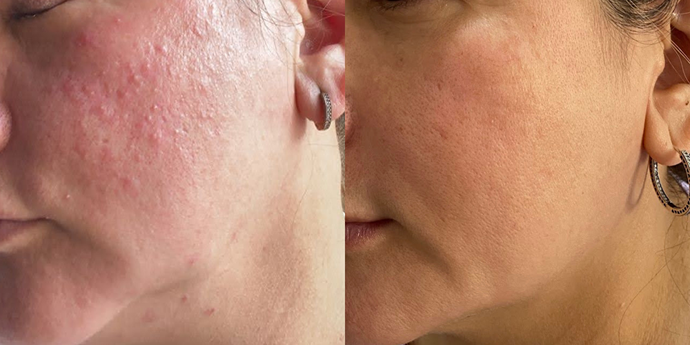 Rosacea pustular