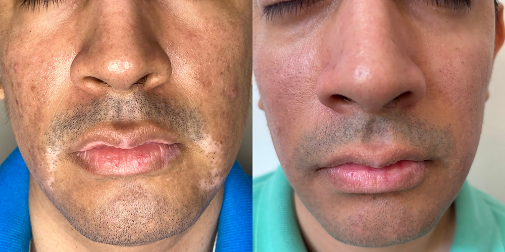 Vitiligo