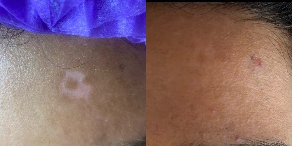Vitiligo
