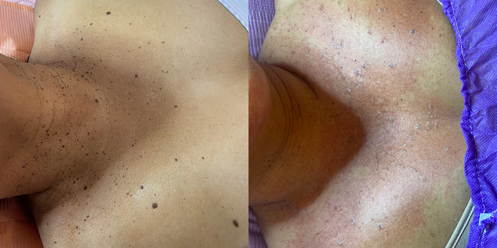 Cauterización de fibromas