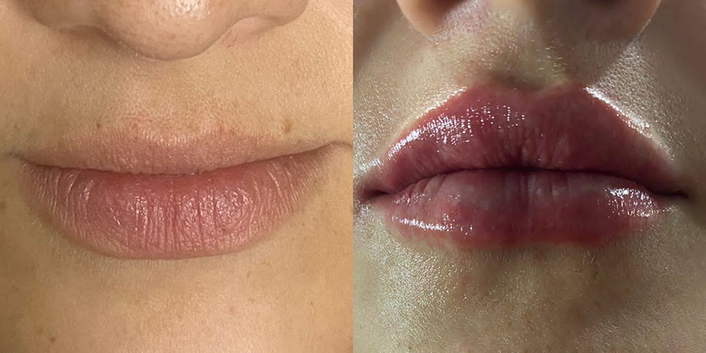 Perfilamiento de labios
